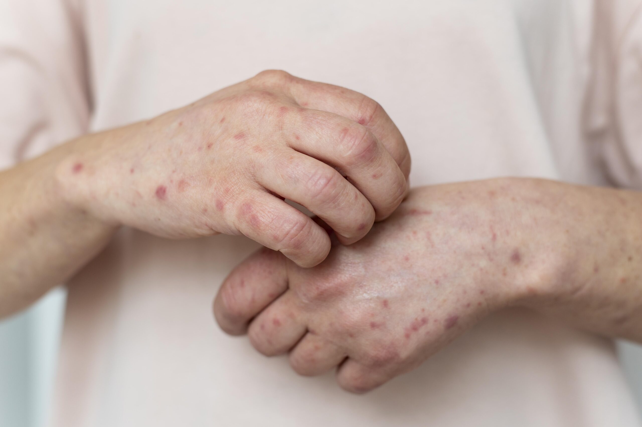 skin-allergy-person-s-arm-hanseníase-pandemia